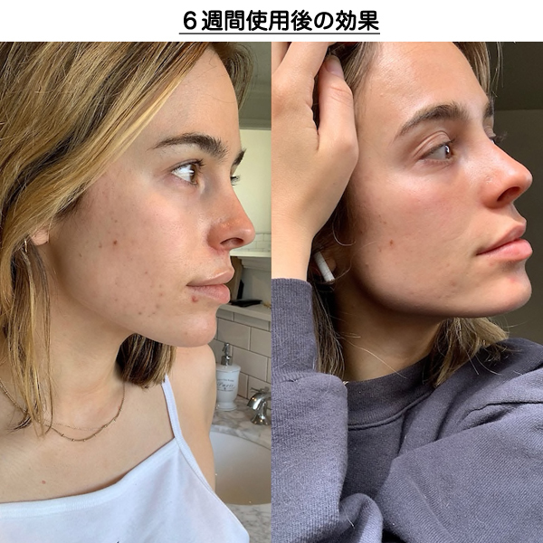 ダーマロジカ☆ニキビに♪レチノール アクネ クリアリングオイル